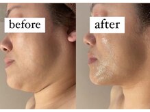 ウィズルーチェ つくばみどりの店(with luce)/二重顎たるみの緩和にV字小顔