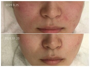 シアン(CYAN)/before/after 赤み