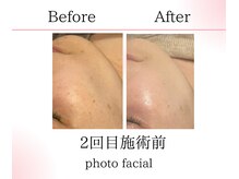 サロンツキ(salon tuki)/お客様症例/光フォト/徳島