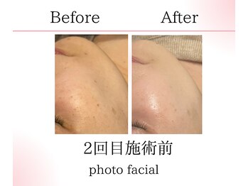 サロンツキ(salon tuki)/お客様症例/光フォト/徳島