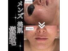 アリミリサロン(A.Rimi.Ri salon)/メンズ☆髭脱毛