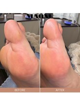 マオヌー(MAONU)/韓国式足裏角質ケア　症例写真