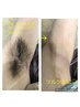 臭い撃退！ワキ毛脱毛　WAX +光脱毛　5500円→3300円！