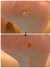 フットケアサロン ラビフット(Rabbi foot)/魚の目放置は支障をきたします