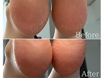 カシェット 広島店(Cachette)/30代女性☆足裏角質ケア90分