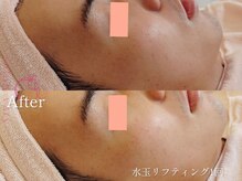 ヴェアリー 広尾(VARY)/1回の効果。水玉リフティング