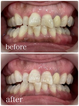 ホワイトニングカフェ 吉祥寺店(WhiteningCafe)/12回コース / ビフォーアフター