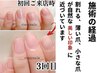 【どこに行っても変わらなかった深爪を改善するコースの初回体験!半額以下】