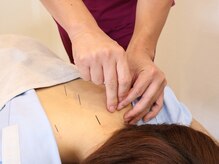 上尾メディケア整骨院 鍼灸院の雰囲気（鍼灸施術で相乗効果◎[上尾/マッサージ/鍼灸/整体/美容鍼/腰痛]）