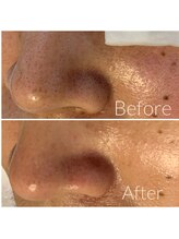 ウエカ(ueka)/隅々まで黒ずみ毛穴改善！！