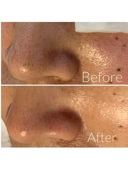 ウエカ(ueka)/隅々まで黒ずみ毛穴改善!!