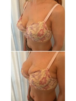 美バストアルファ(美bust α)/【バストアップ】症例