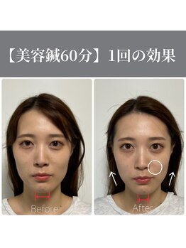 サンクエール 代官山鍼灸院(CINQ AILES)/美容鍼灸　眼精疲労・シワ改善