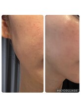 ラナン(ranan)/チョウザメエキス