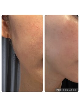 ラナン(ranan)/チョウザメエキス