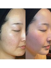 エラ(ella)/20代後半　肌質改善