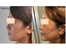 リズ(rE:S)/インモードリフティング40代後半