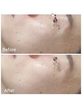 レン(Ren)/ラテスパ〈毛穴洗浄〉メンズ