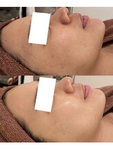 ミベル(MeBell)/ハーブリプロ→セラピール