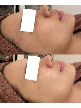 ミベル(MeBell)/ハーブリプロ→セラピール