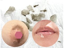 ラヴァコケット 長堀橋店(Lova'coquette)/施術後は【ROMAPINK】