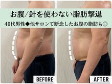 ソルニスクア(Solnis.qua)/痩身☆脂肪分解/ハイパーナイフ