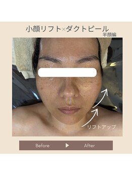 ギンザ リボーン(Ginza Reborn)の写真/【結果重視の方必見!!】しわ・二重アゴ・たるみ・ほうれい線を改善◎小顔で若々しい見た目に