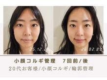 ルナビューティー 赤坂(LUNA beauty)/小顔コルギ　7回前/後