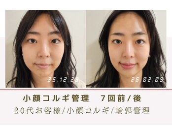 ルナビューティー 赤坂(LUNA beauty)/小顔コルギ　7回前/後
