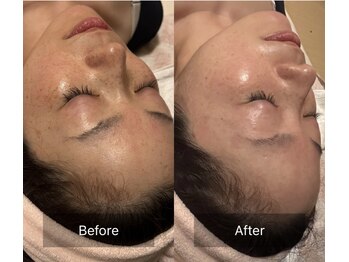 癒える(ielu)/陶肌トリートメント★ハーブ