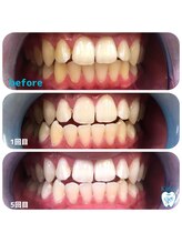 キラット 高知中万々店(Kiratt)/【クリスタルホワイトニング】