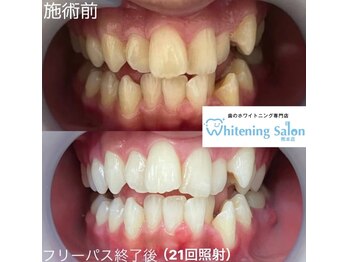 ホワイトニングサロン 熊本店/メンズにもホワイトニング