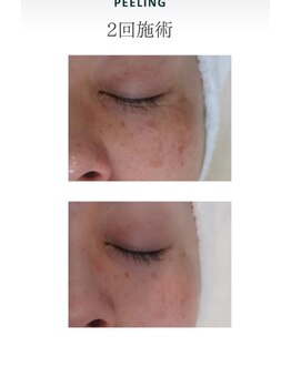 ルアナ(Luana)/ガリレオピーリング