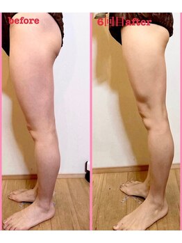 ミレボ(Me.rebo)/脂肪撃退コースbefore→after