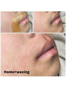 ホームプラスワクシング(Home＋waxing)/キッズ脱毛もあります◎