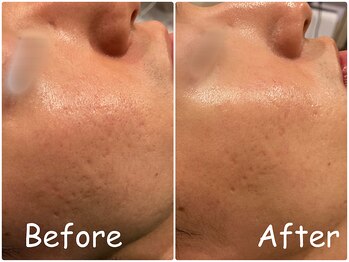 ラディアント たまプラーザ/肌の凸凹表面改善