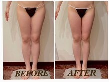 プリマ(Prima)/【2回施術】　BEFORE&AFTER