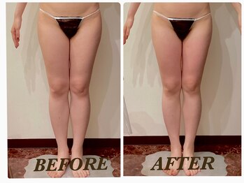 プリマ(Prima)/【2回施術】 BEFORE&AFTER