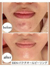 ザ エステティック福岡/EIEN・バクチオールのWメニュー