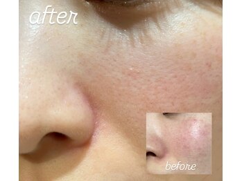 グレアージュ(GLEAGE)/ハーブピーリングで肌質改善!