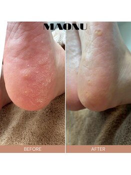 マオヌー(MAONU)/韓国式足裏角質ケア　症例写真