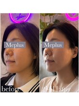 ミープラス(Me+)/小顔マイクロ波リフト
