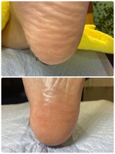 ドクターネイル爪革命 所沢西店/ガサガサ角質をツルツルかかとへ