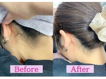 ミセレル 大村店の雰囲気（20代女性　うなじ脱毛のビフォーアフター。）