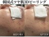 人気No.1【しぶといニキビ&毛穴詰まり】韓国式つや肌3Dピーリング