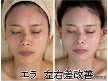 リンダ(Rinda)/お顔エラ&左右差改善