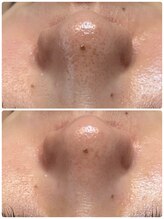 ティアーナ(Tiaana)/毛穴洗浄