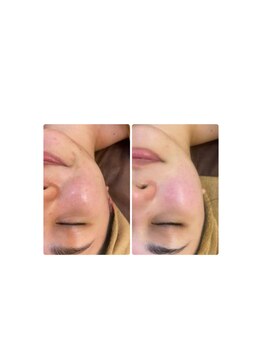 そらまめ/韓国白玉セラピー3回目