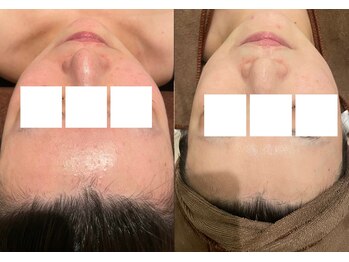 フォルチェ 春日(Folche)/お肌を綺麗に/肌質改善をしたい