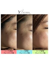 リノレリチア 心斎橋 新町店/KMPハーブピーリング